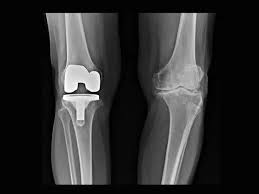 knee replacement