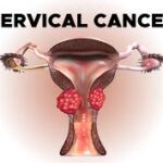 cervical cancer treatment
