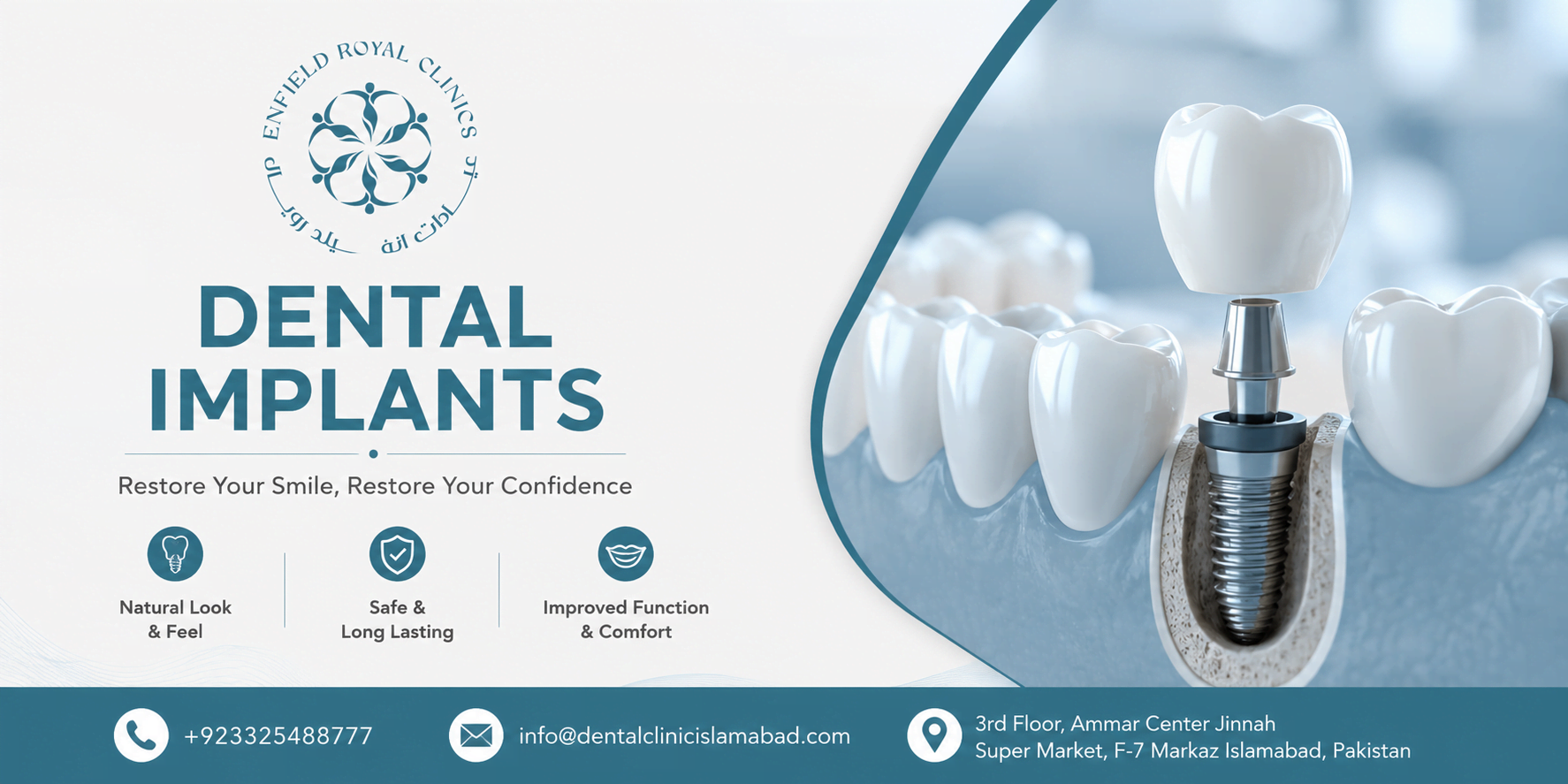 Best Dental Implants in Islamabad