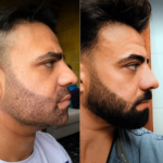 The Emotional and Psychological Impact of Beard Hair Transplants in Dubai