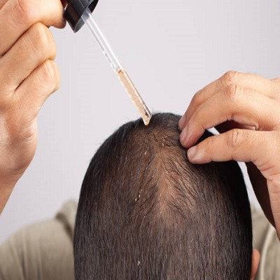 How Effective Is Finasteride for Hair Loss in Dubai?