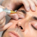 Rejuvenate Your Eyes with Plexr Plasma Eye Lift in Abu Dhabi