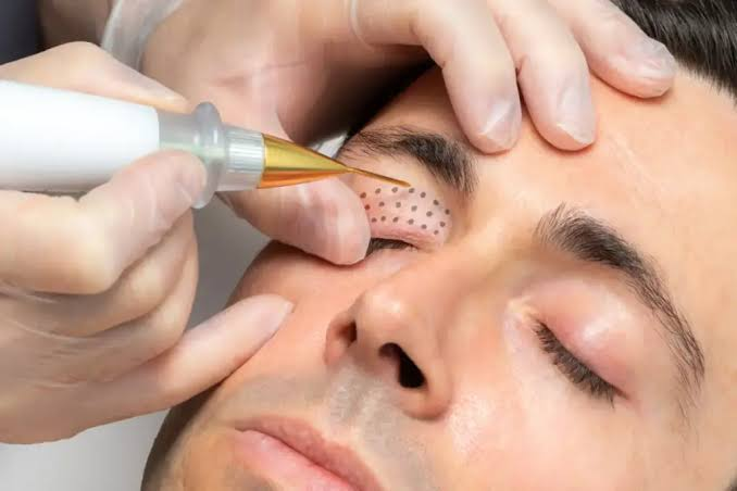 Rejuvenate Your Eyes with Plexr Plasma Eye Lift in Abu Dhabi