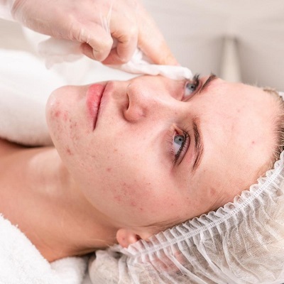Organic Peel