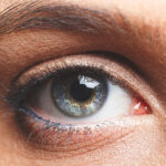 Can Eye Bag removal correct persistent eye puffiness