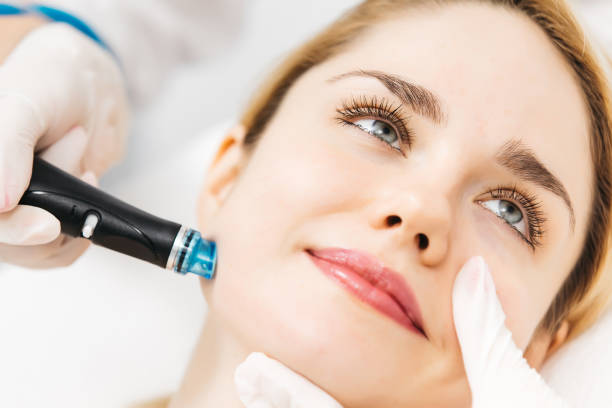 Can HydraFacial Help Reduce Blackheads and Whiteheads