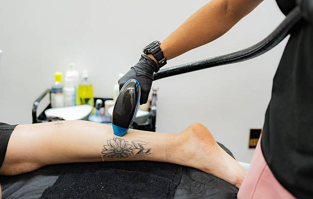 Can Laser Tattoo Removal Fade Cosmetic Tattoos