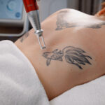 Can Laser Tattoo Removal Remove Stubborn Ink