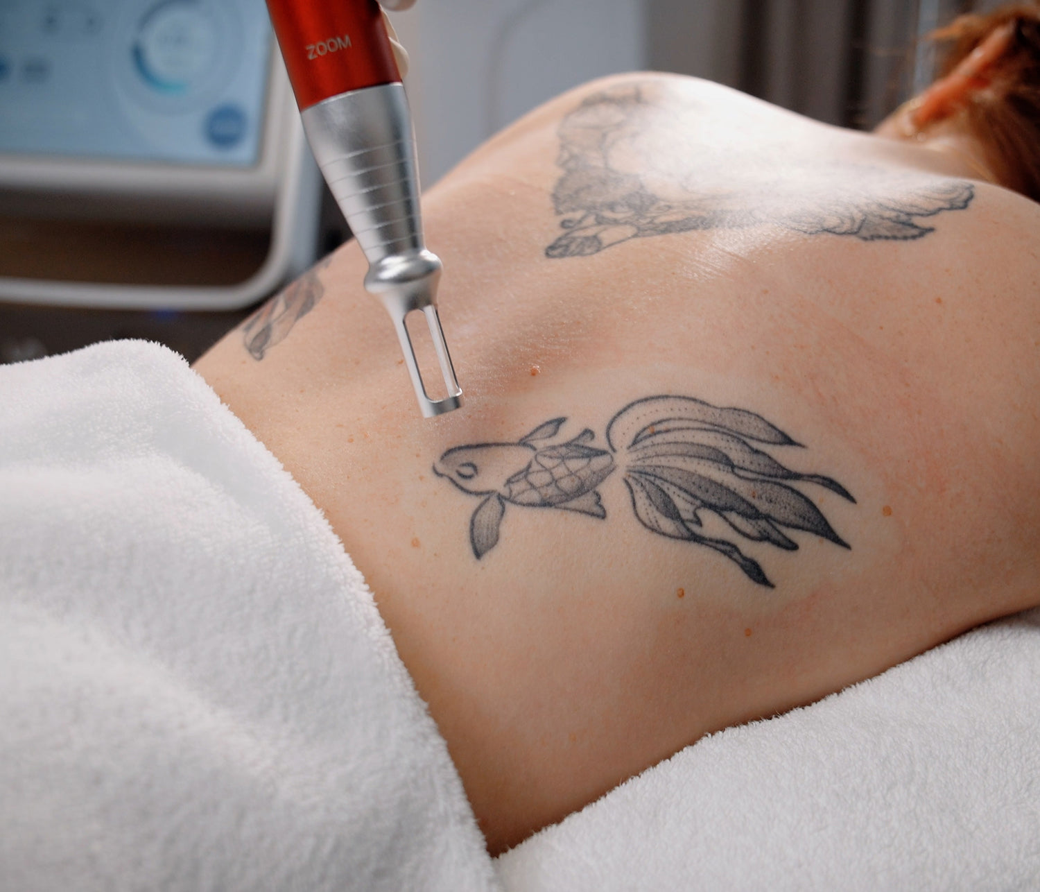 Can Laser Tattoo Removal Remove Stubborn Ink