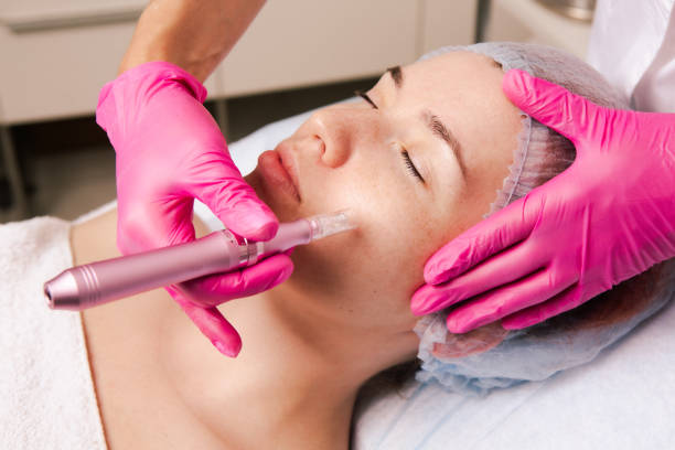 Can Microneedling Tighten Loose Facial Skin Naturally