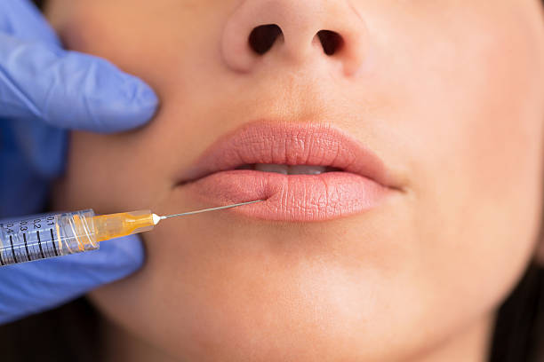 Can Russian Lip Fillers Lift the Lip Appearance
