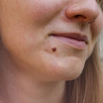 Can Warts Removal Treatment Remove Warts Quickly
