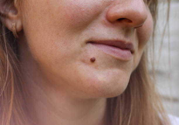 Can Warts Removal Treatment Remove Warts Quickly