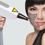 Does Laser Carbon Peel Help Remove Surface Impurities