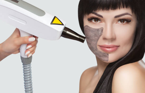 Does Laser Carbon Peel Help Remove Surface Impurities