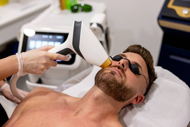 How Does Beard Laser Hair Removal Stop Razor Bumps