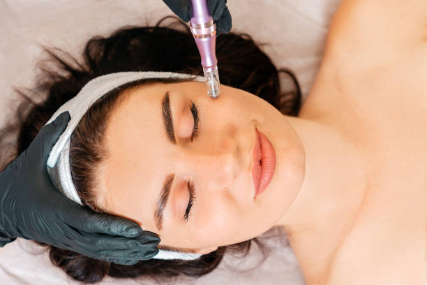 How Does Dermapen Treatment Refresh Your Skin