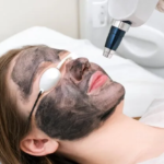 Laser Carbon Peel Abu Dhabi