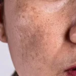 How Does Pigmentation Treatment Work