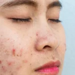 How Does Skin Lesion Removal Work Safely