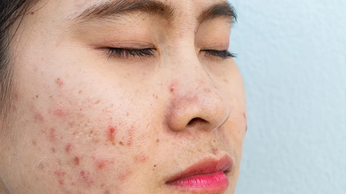 How Does Skin Lesion Removal Work Safely
