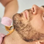How Long Does Beard Laser Hair Removal Last