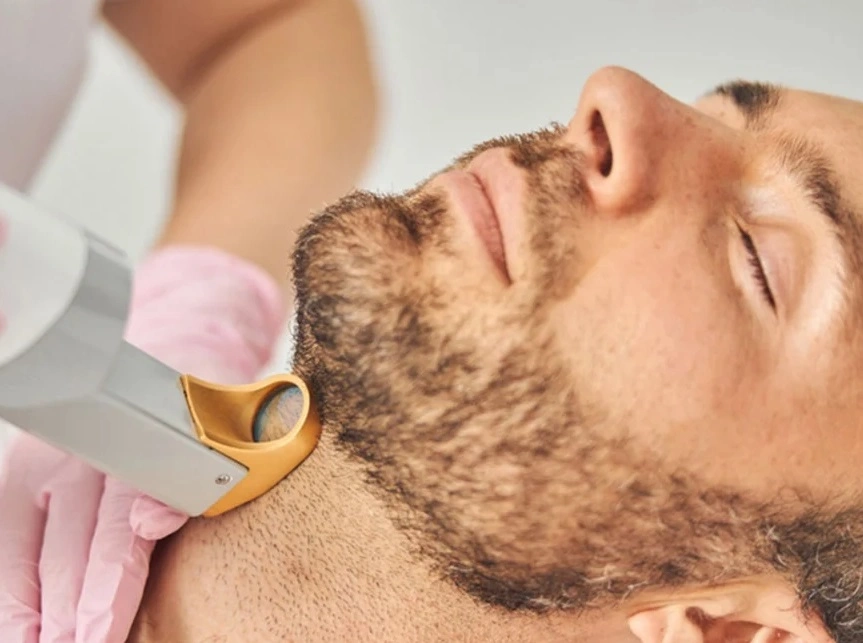 How Long Does Beard Laser Hair Removal Last