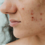 How Many Sessions Does Laser Acne Scar Treatment Need