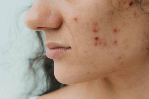 How Many Sessions Does Laser Acne Scar Treatment Need