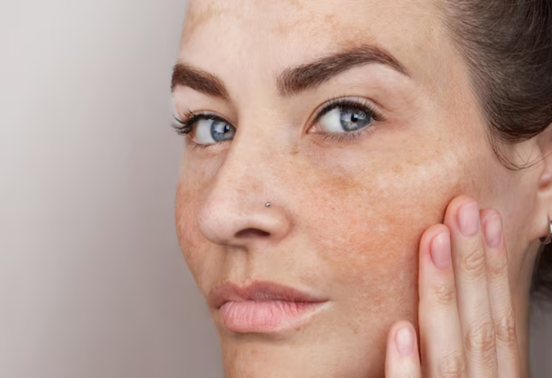 Pigmentation Treatment in Abu Dhabi