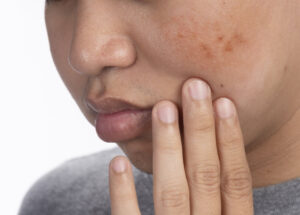 Dermal Pigmentation in Abu Dhabi