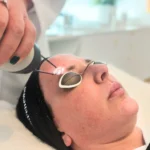 How does Pico Laser Treatment help reduce dark spots