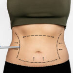 How does liposuction help define the waist and body profile