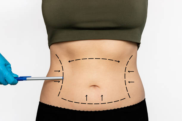 How does liposuction help define the waist and body profile