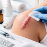 Keloid Treatment Abu Dhabi