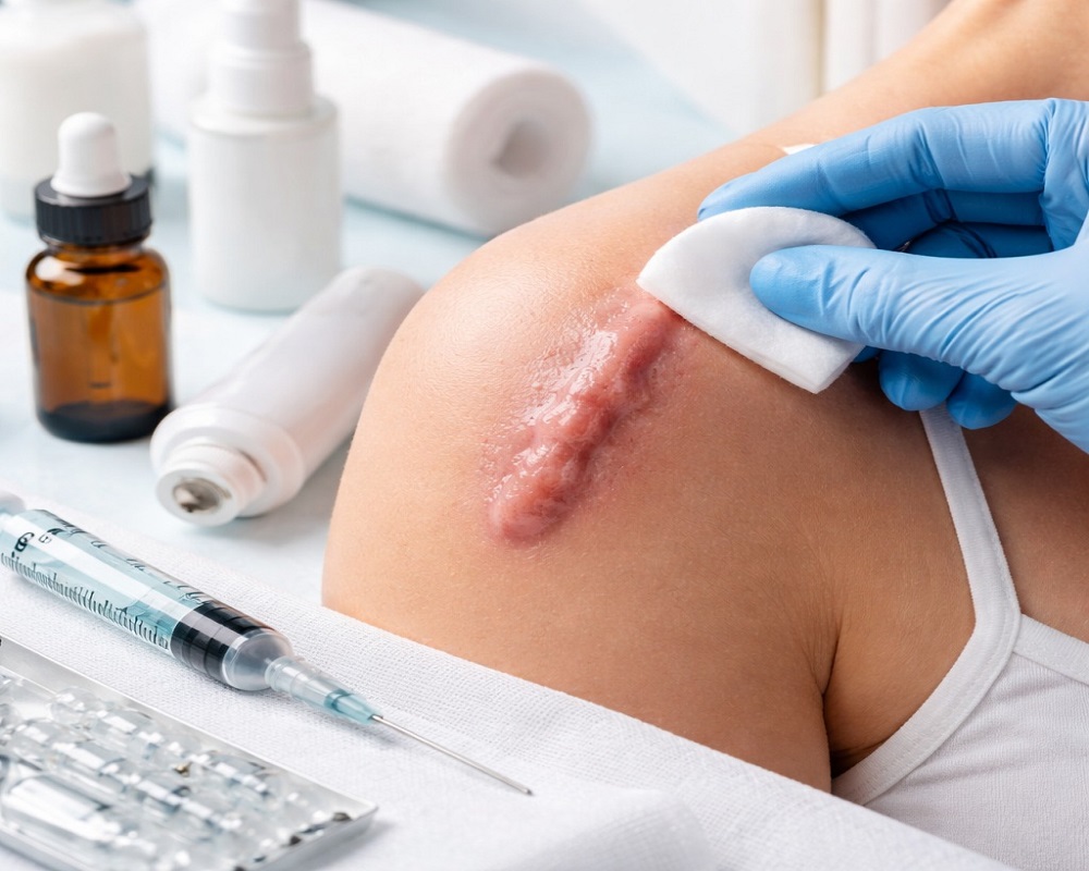 Keloid Treatment Abu Dhabi