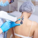 Is Laser Tattoo Removal Right for Old Tattoos