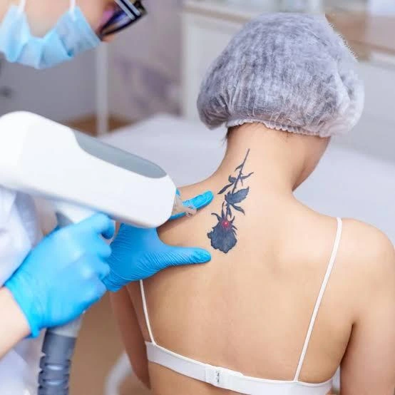 Is Laser Tattoo Removal Right for Old Tattoos