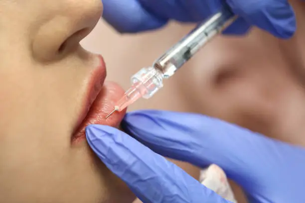 Is Lip Fillers Right for Thin Lips and Lines