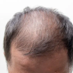 Scarless hair transplant in Abu Dhabi