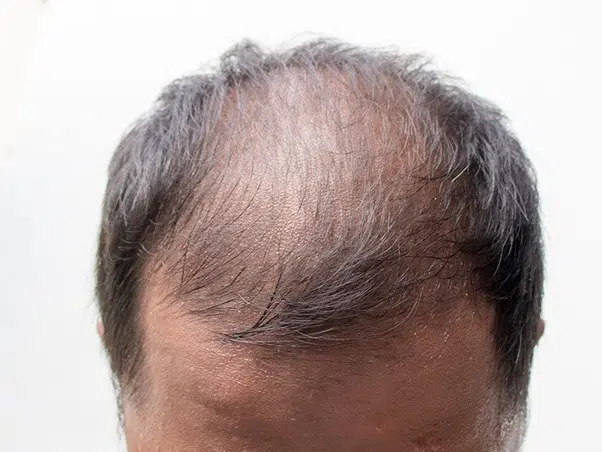 Scarless hair transplant in Abu Dhabi