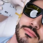 What Makes Beard Laser Hair Removal Effective