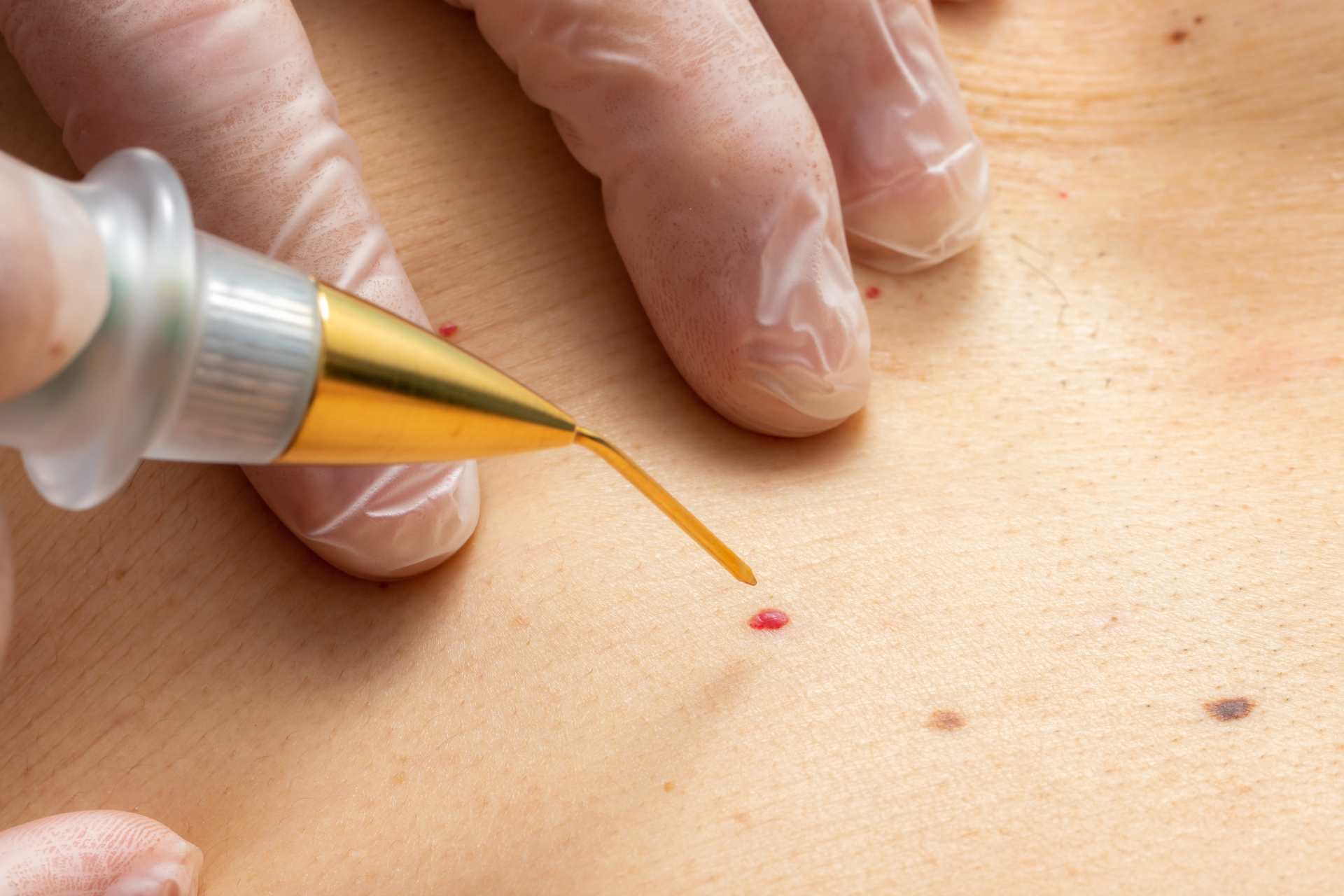 Warts Removal Treatment Abu Dhabi