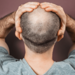 Scalp Micropigmentation Abu Dhabi
