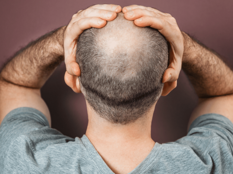 Scalp Micropigmentation Abu Dhabi