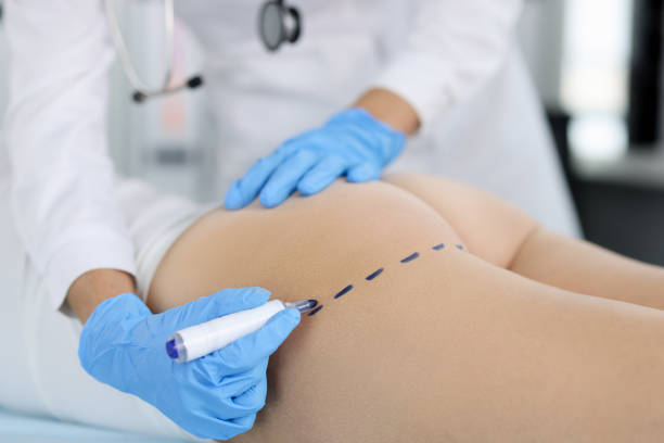 Achieve Subtle-Looking Body Enhancement with Body Fillers