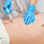 Achieve a More Harmonious Chest Appearance with Gynecomastia Surgery
