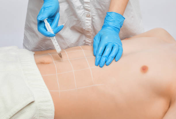 Achieve a More Harmonious Chest Appearance with Gynecomastia Surgery