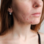 Can Acne Treatment Help Treat Persistent Acne Problems