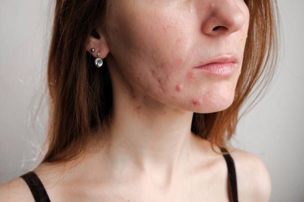 Can Acne Treatment Help Treat Persistent Acne Problems